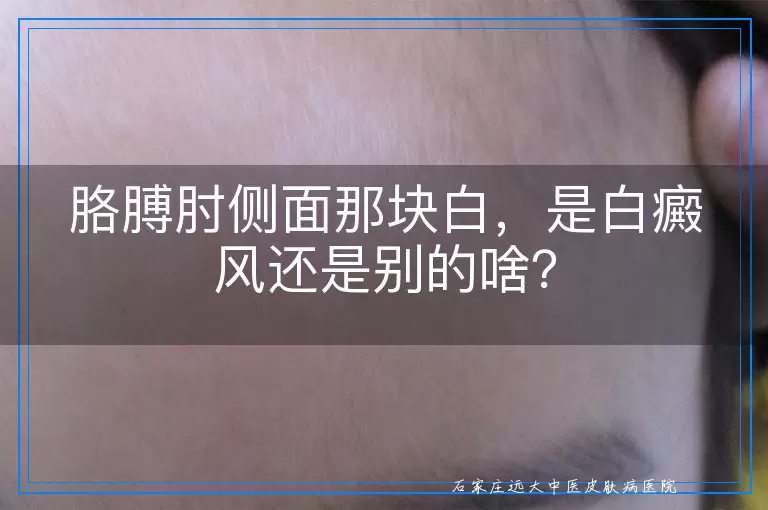 胳膊肘侧面那块白，是白癜风还是别的啥？