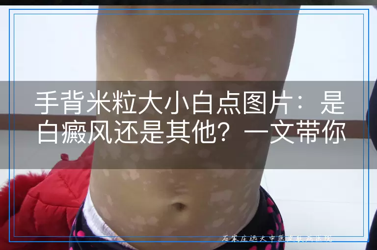 手背米粒大小白点图片：是白癜风还是其他？一文带你了解清楚