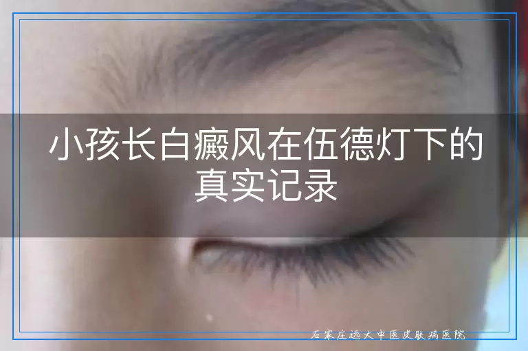 小孩长白癜风在伍德灯下的真实记录