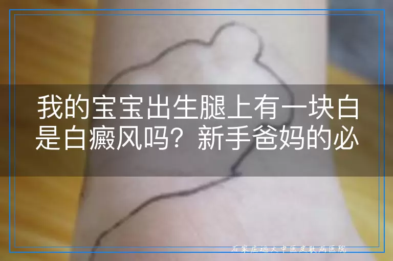 我的宝宝出生腿上有一块白是白癜风吗？新手爸妈的必读指南！