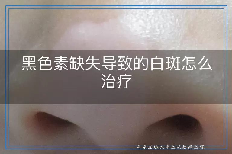 黑色素缺失导致的白斑怎么治疗