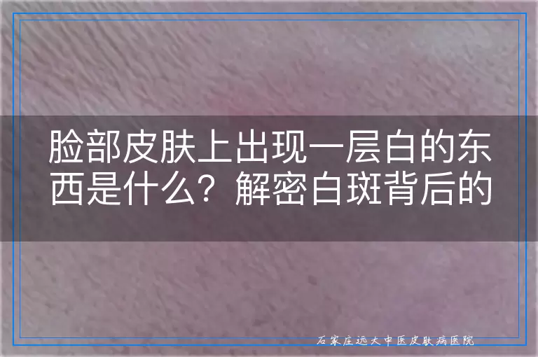脸部皮肤上出现一层白的东西是什么？解密白斑背后的真相！