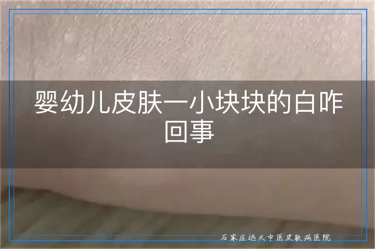 婴幼儿皮肤一小块块的白咋回事