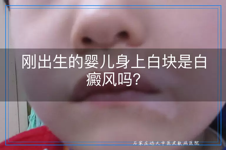 刚出生的婴儿身上白块是白癜风吗？