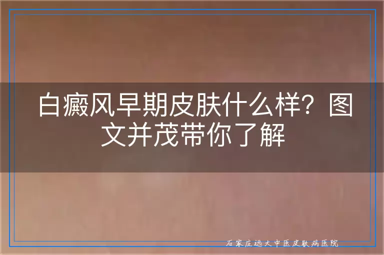 白癜风早期皮肤什么样？图文并茂带你了解