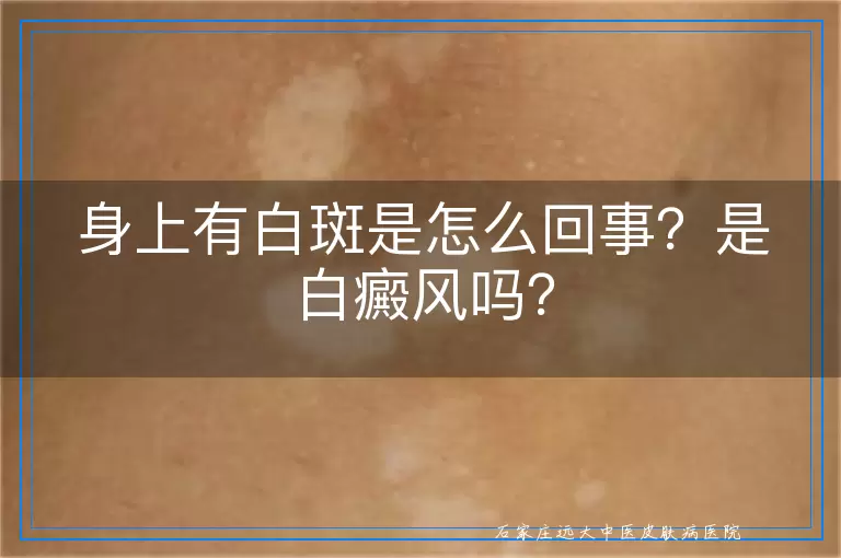 身上有白斑是怎么回事？是白癜风吗？