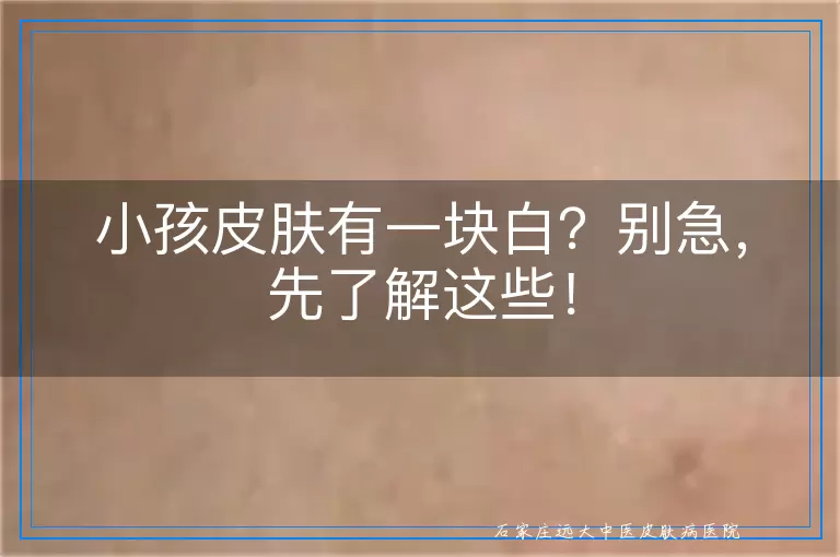 小孩皮肤有一块白？别急，先了解这些！