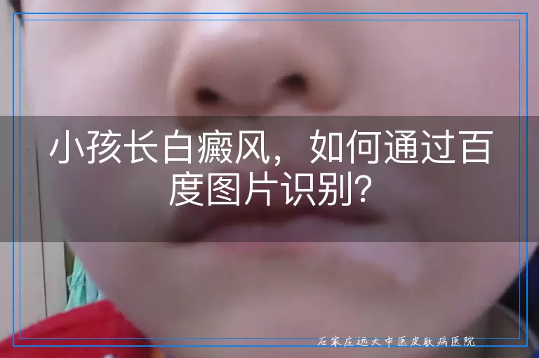 小孩长白癜风，如何通过百度图片识别？
