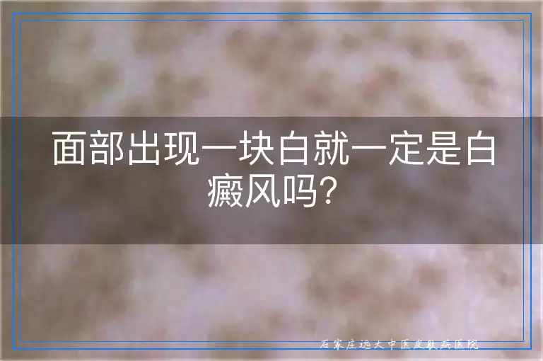 面部出现一块白就一定是白癜风吗？