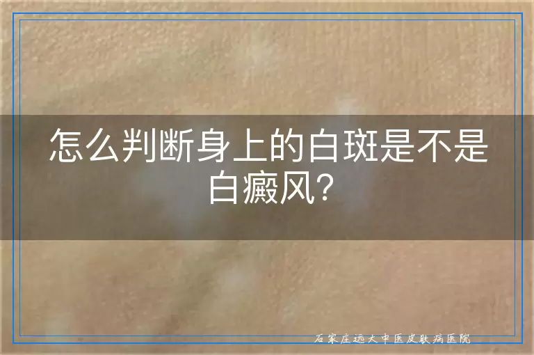 怎么判断身上的白斑是不是白癜风？