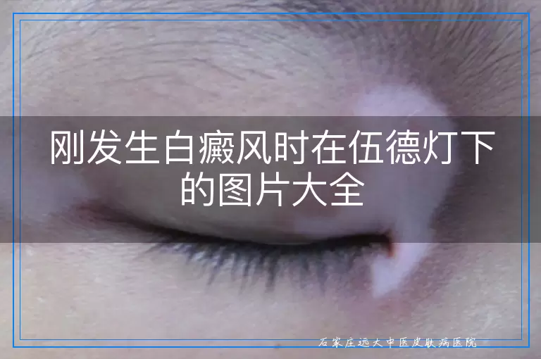 刚发生白癜风时在伍德灯下的图片大全