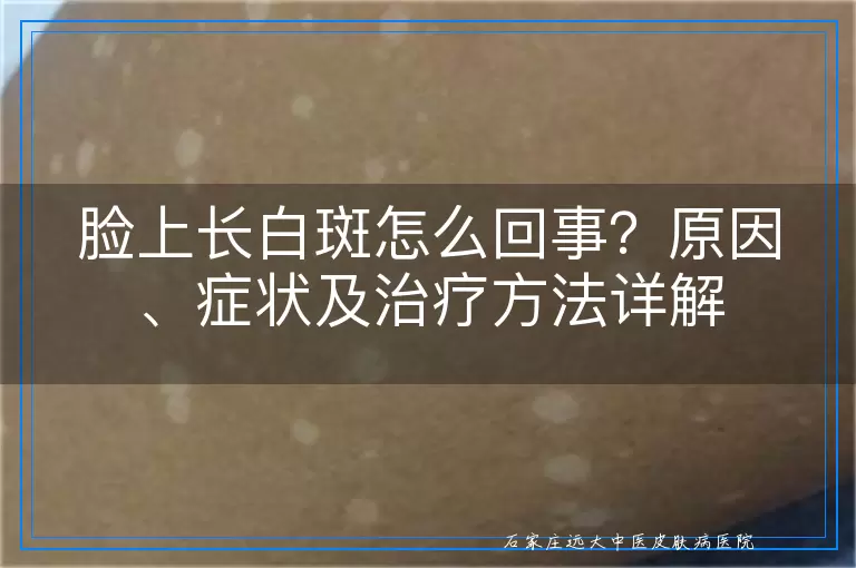 脸上长白斑怎么回事？原因、症状及治疗方法详解