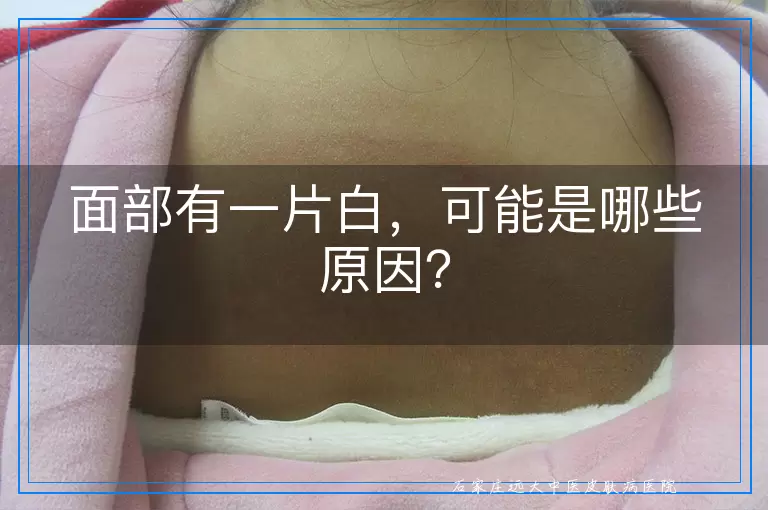 面部有一片白，可能是哪些原因？
