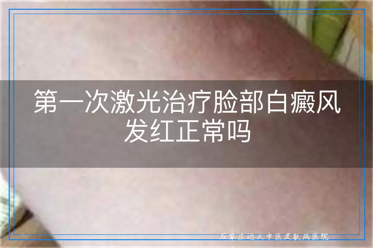 第一次激光治疗脸部白癜风发红正常吗