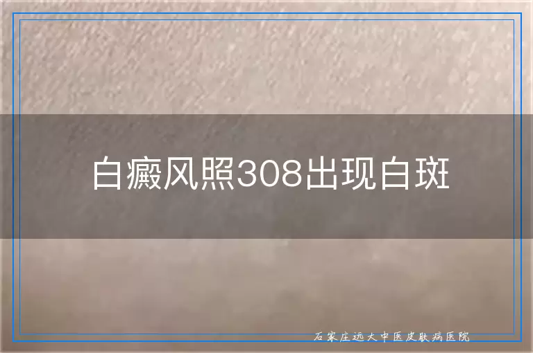 白癜风照308出现白斑