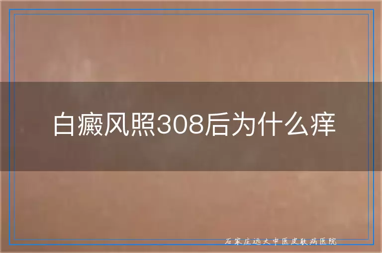 白癜风照308后为什么痒
