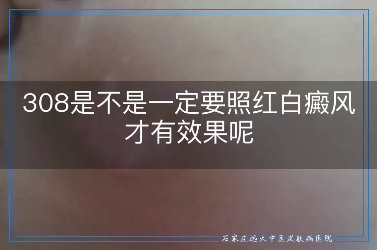 308是不是一定要照红白癜风才有效果呢