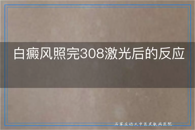 白癜风照完308激光后的反应