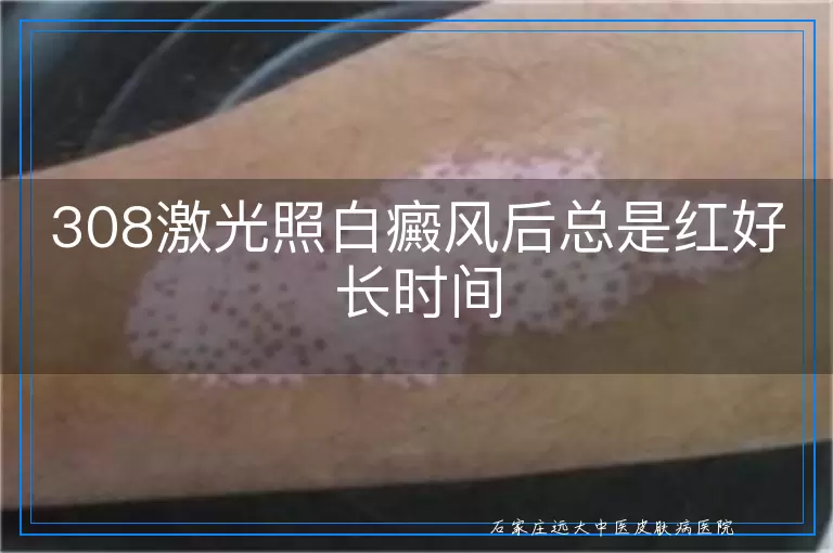 308激光照白癜风后总是红好长时间