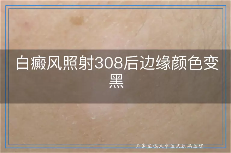 白癜风照射308后边缘颜色变黑