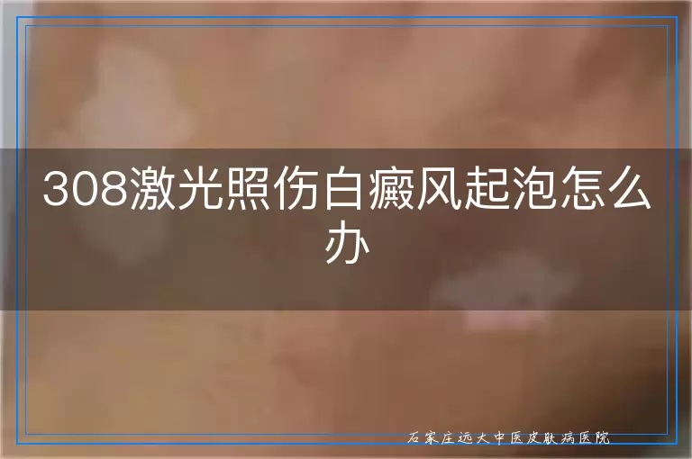 308激光照伤白癜风起泡怎么办