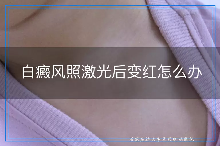 白癜风照激光后变红怎么办
