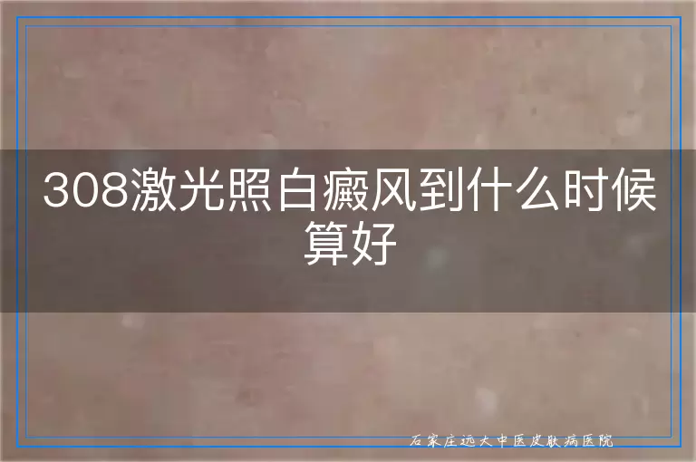 308激光照白癜风到什么时候算好