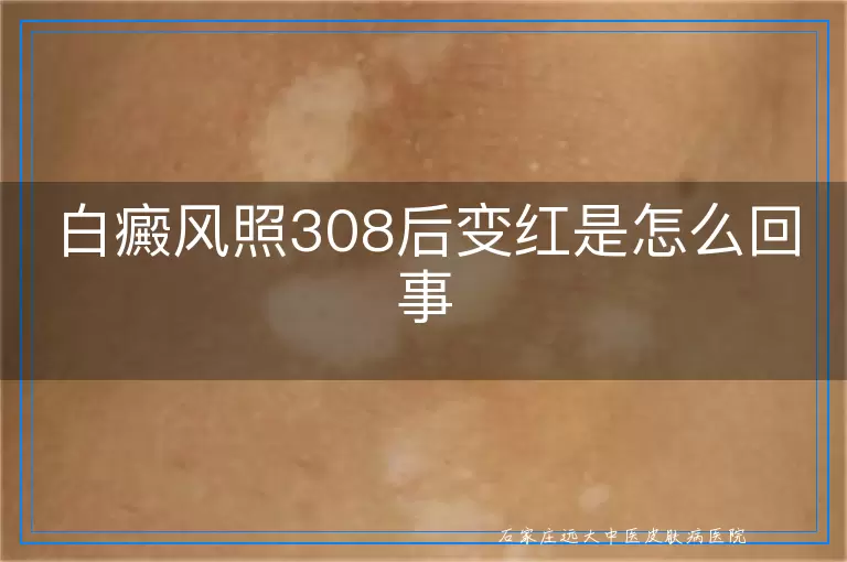 白癜风照308后变红是怎么回事