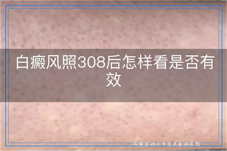 白癜风照308后怎样看是否有效