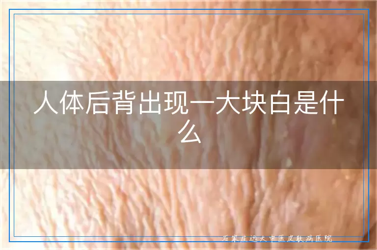 人体后背出现一大块白是什么