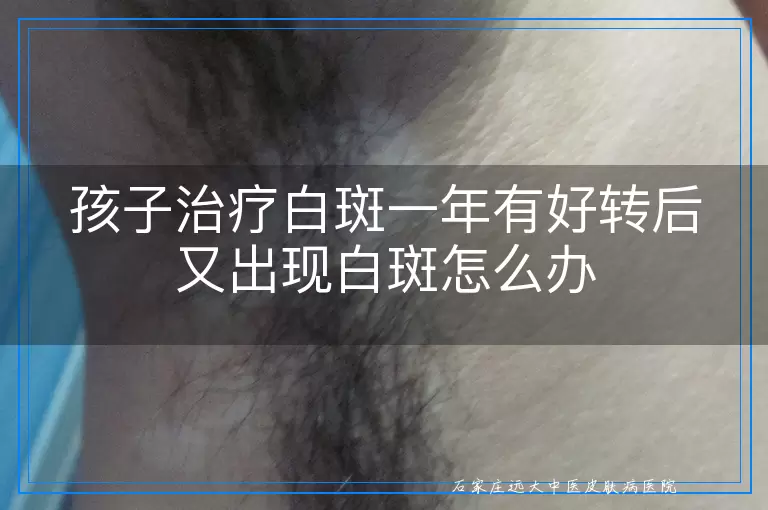 孩子治疗白斑一年有好转后又出现白斑怎么办