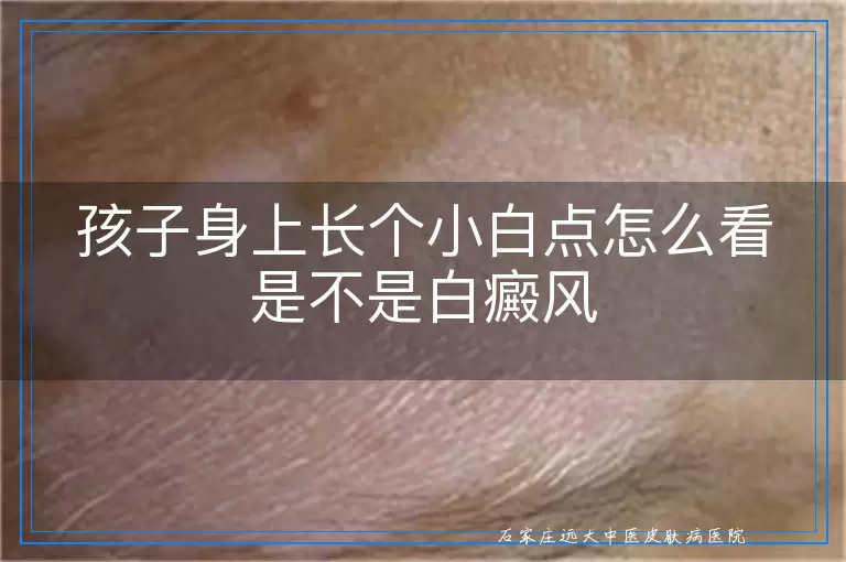 孩子身上长个小白点怎么看是不是白癜风