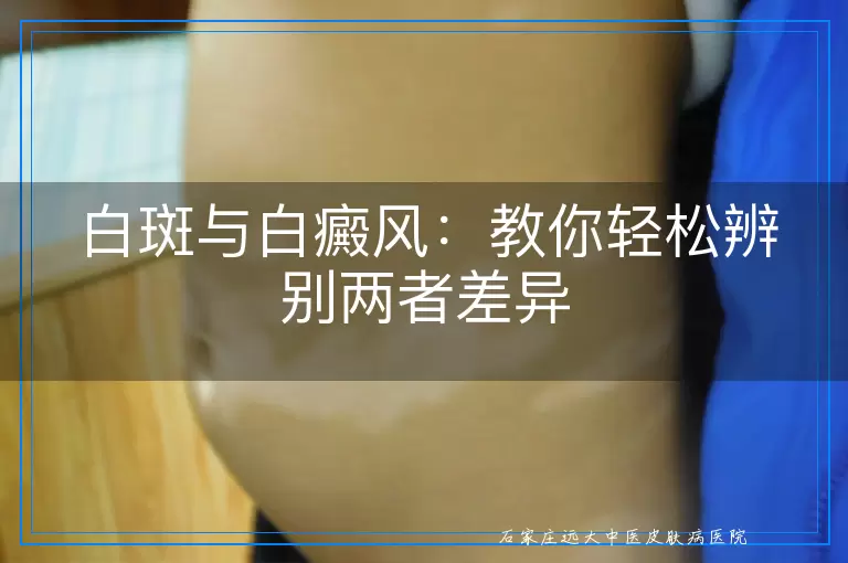 白斑与白癜风：教你轻松辨别两者差异