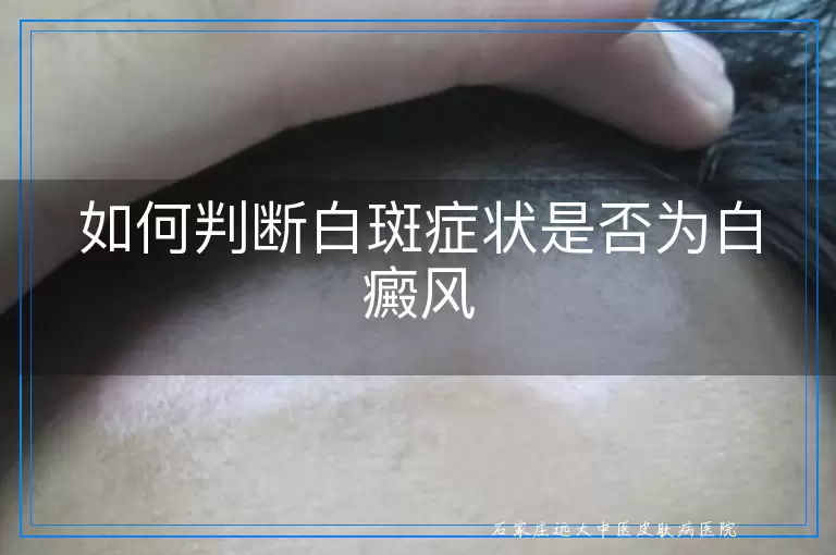 如何判断白斑症状是否为白癜风