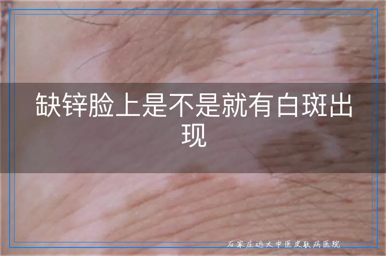 缺锌脸上是不是就有白斑出现