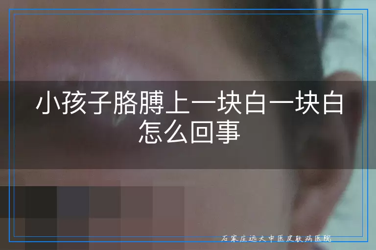 小孩子胳膊上一块白一块白怎么回事