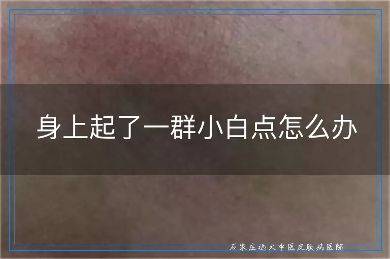 身上起了一群小白点怎么办