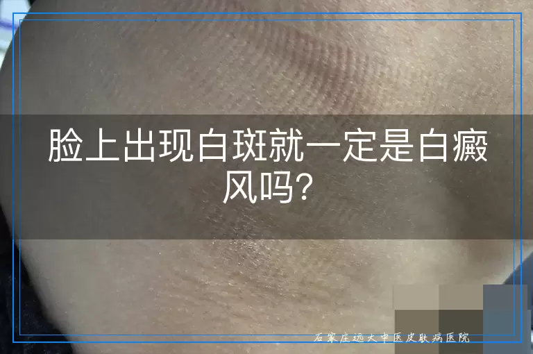 脸上出现白斑就一定是白癜风吗？