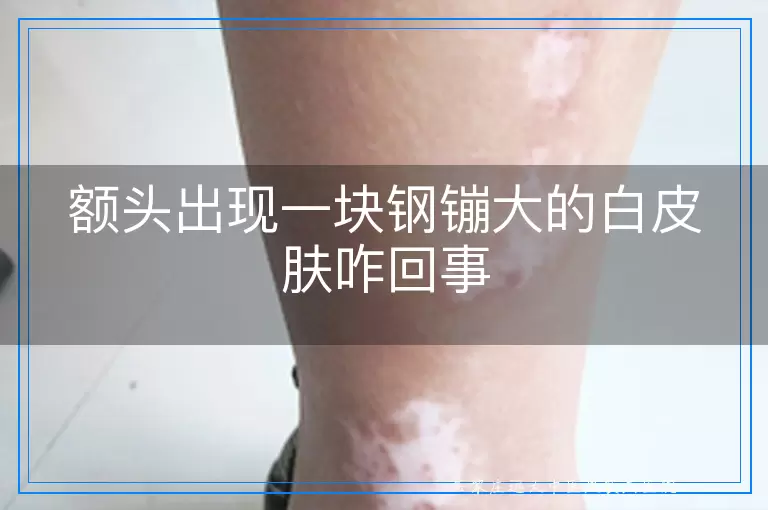 额头出现一块钢镚大的白皮肤咋回事