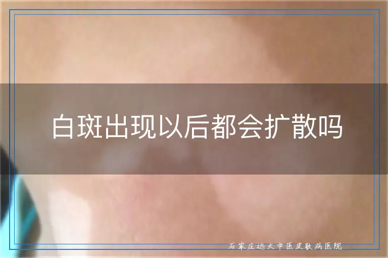 白斑出现以后都会扩散吗