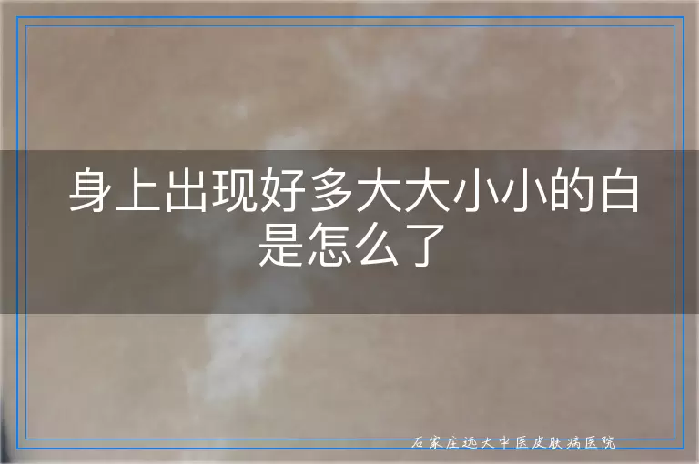 身上出现好多大大小小的白是怎么了