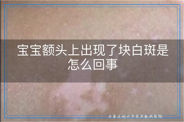 宝宝额头上出现了块白斑是怎么回事