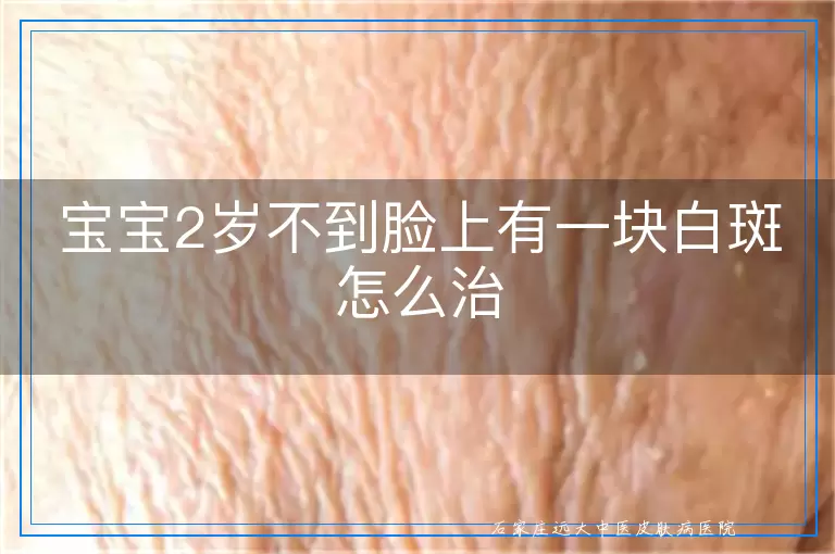 宝宝2岁不到脸上有一块白斑怎么治