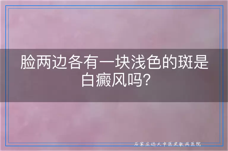 脸两边各有一块浅色的斑是白癜风吗？
