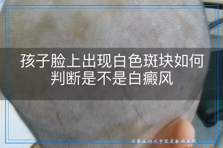 孩子脸上出现白色斑块如何判断是不是白癜风