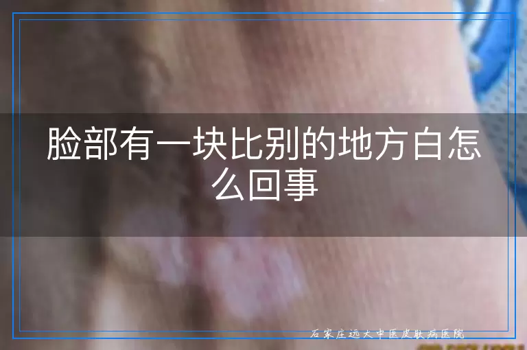 脸部有一块比别的地方白怎么回事