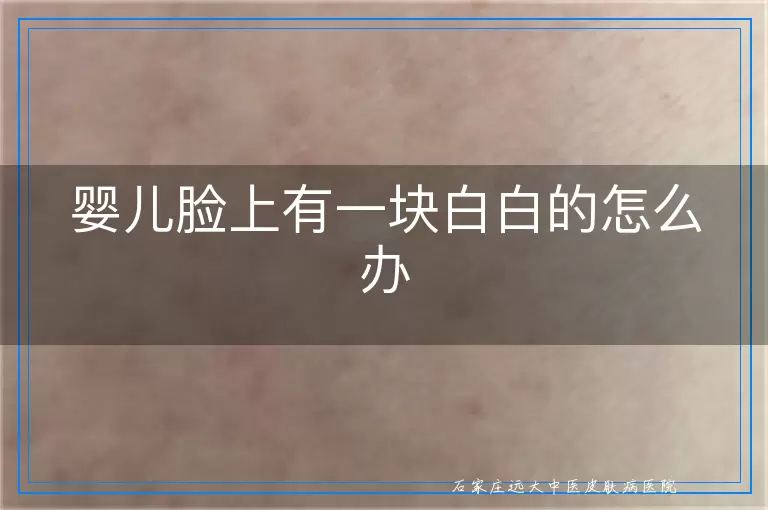 婴儿脸上有一块白白的怎么办
