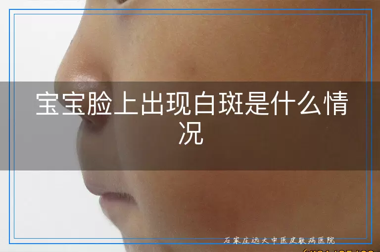 宝宝脸上出现白斑是什么情况
