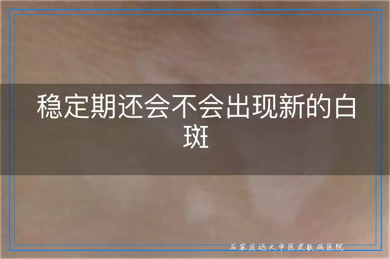 稳定期还会不会出现新的白斑