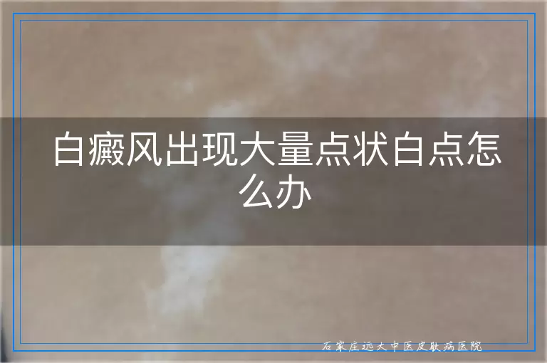 白癜风出现大量点状白点怎么办